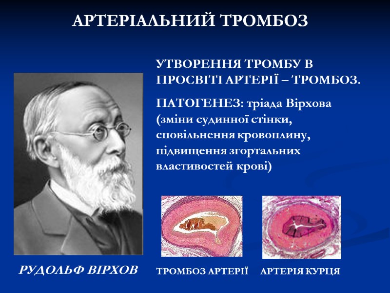 АРТЕРІАЛЬНИЙ ТРОМБОЗ РУДОЛЬФ ВІРХОВ ТРОМБОЗ АРТЕРІЇ АРТЕРІЯ КУРЦЯ УТВОРЕННЯ ТРОМБУ В ПРОСВІТІ АРТЕРІАЛЬНИЙ ТРОМБОЗ РУДОЛЬФ ВІРХОВ ТРОМБОЗ АРТЕРІЇ АРТЕРІЯ КУРЦЯ УТВОРЕННЯ ТРОМБУ В ПРОСВІТІ
